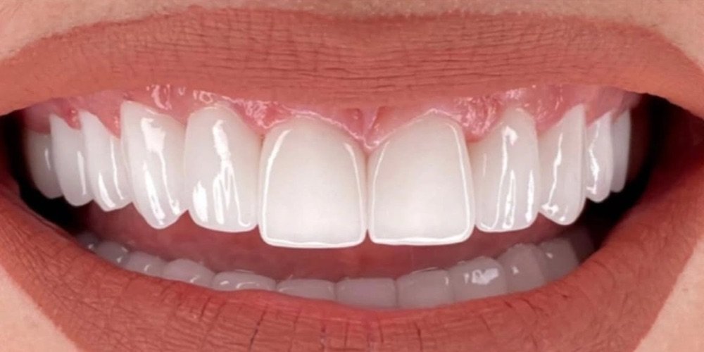 A patient's smile after porcelain veneers at Esteteeth