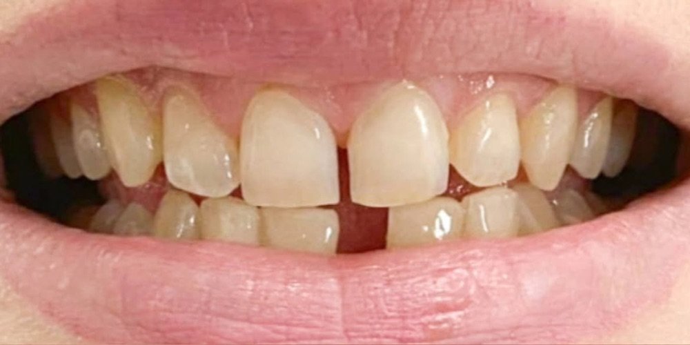 The same patient's smile before treatment