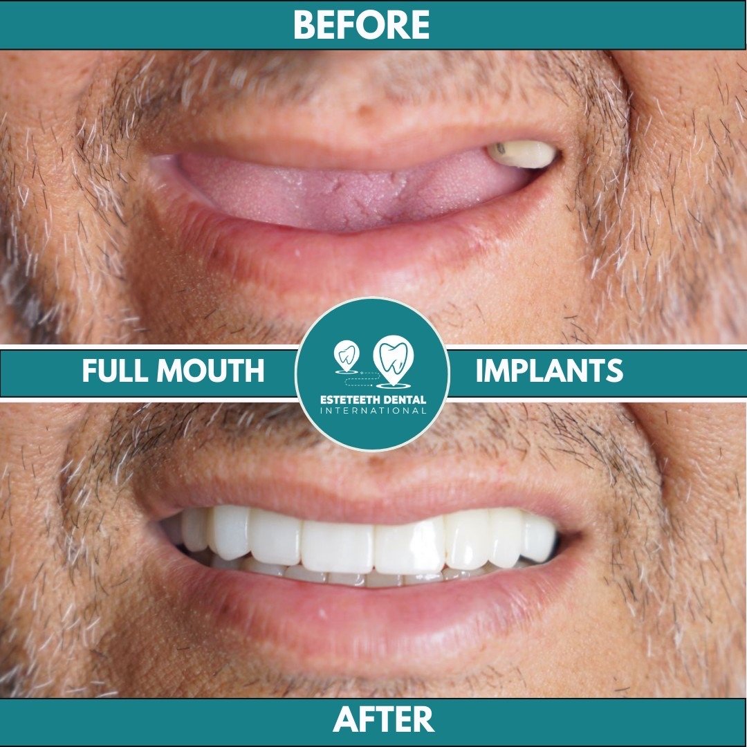 Before and after full mouth implants