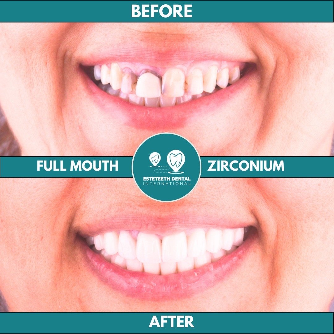 Before and after zirconium crowns