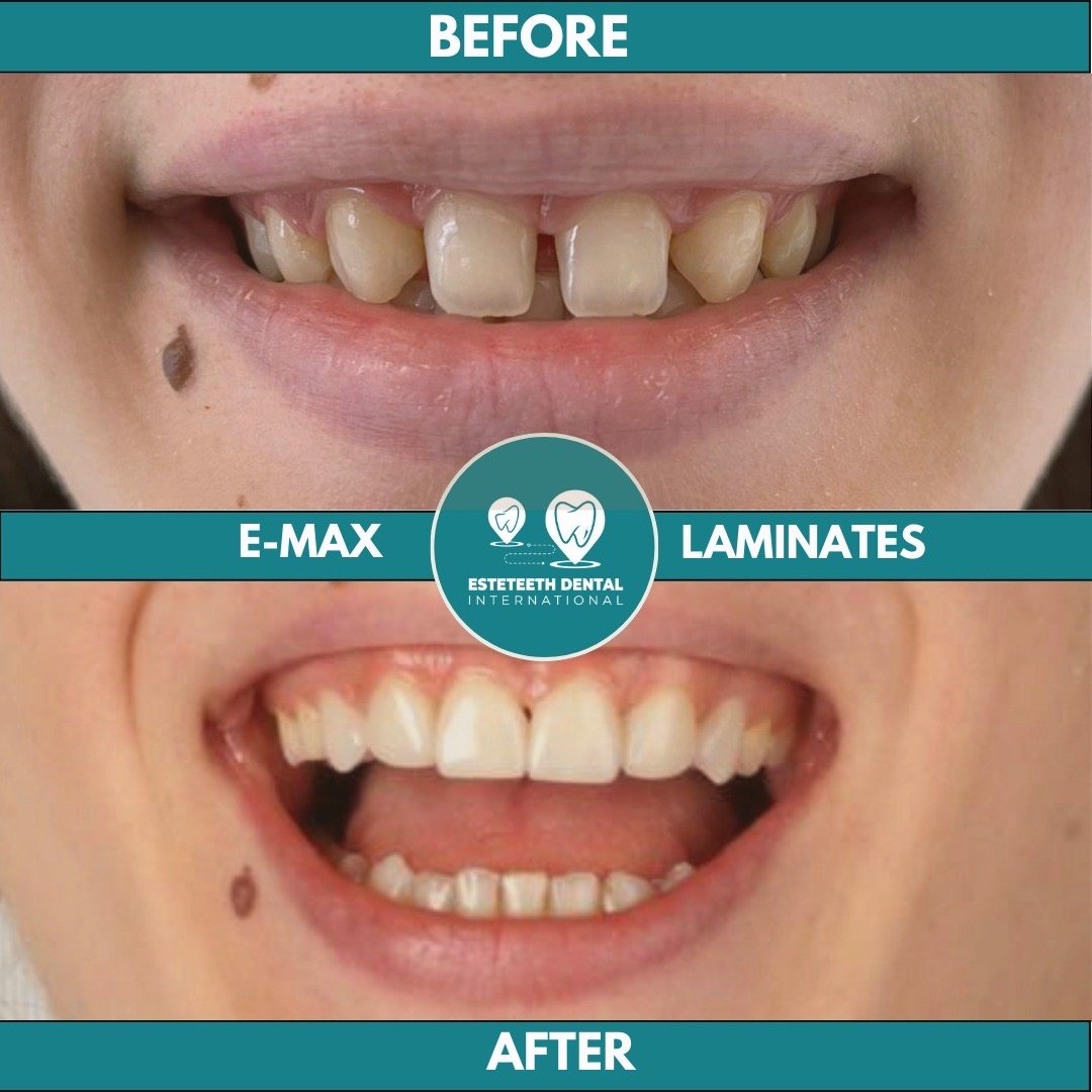 Before and after E-MAX laminates