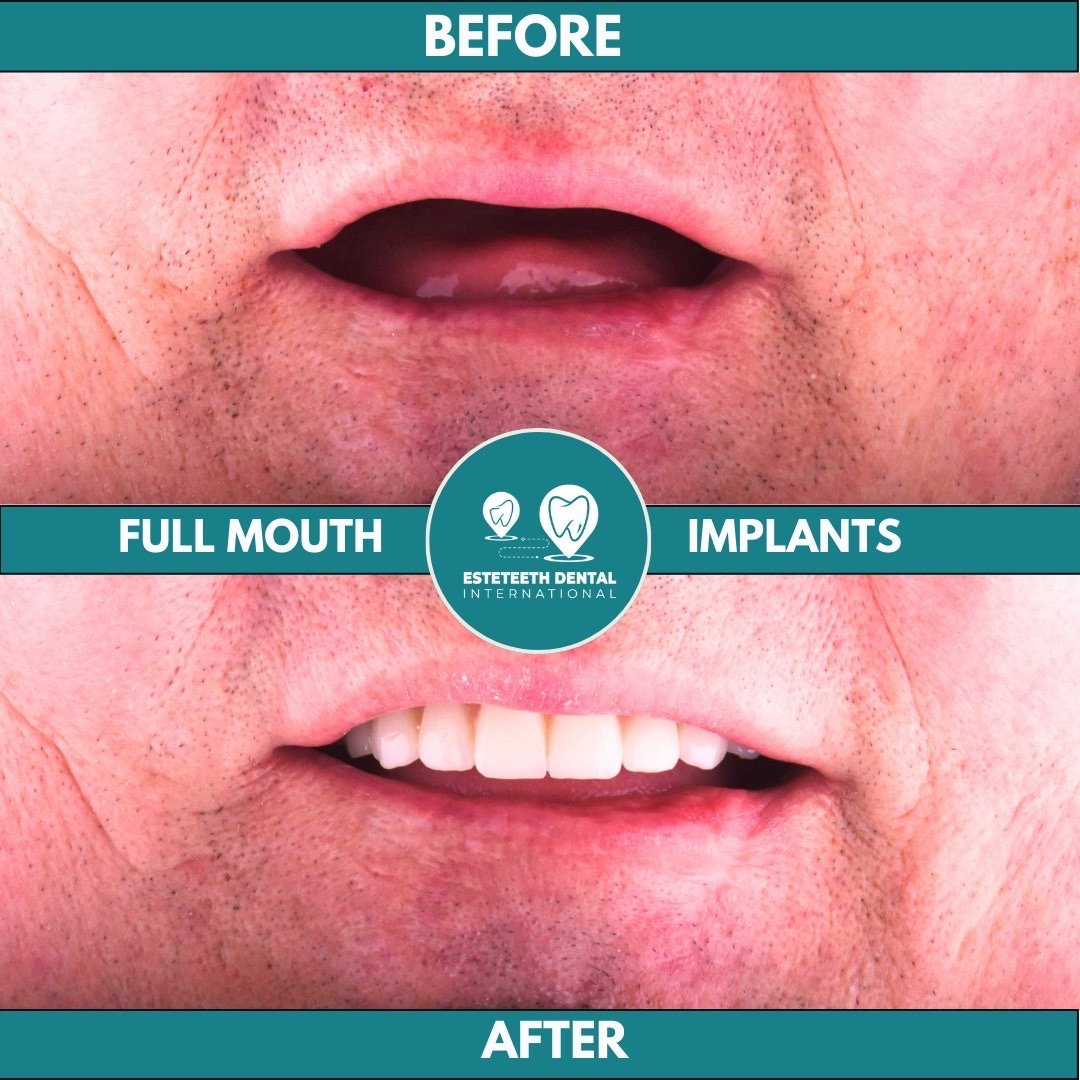 Before and after full mouth implants