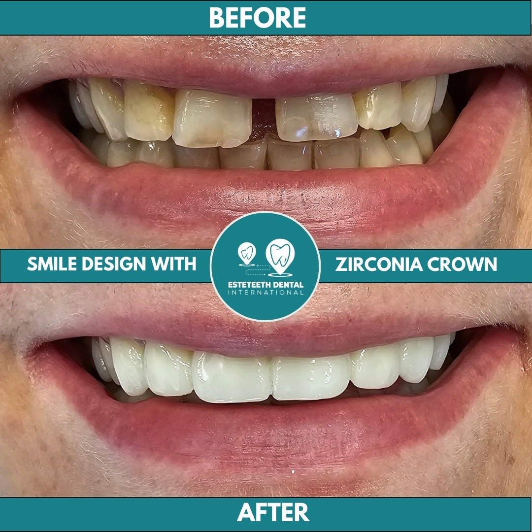 Before and after smile design with zirconia crown