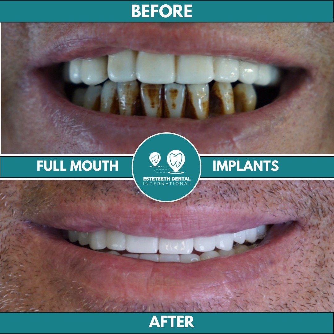 Before and after full mouth implants