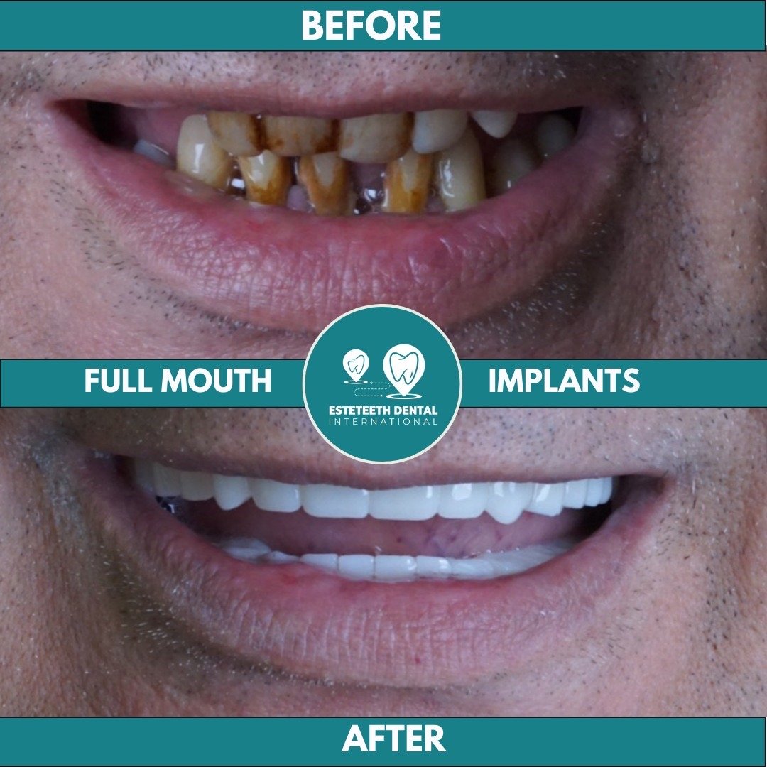 Before and after full mouth implants