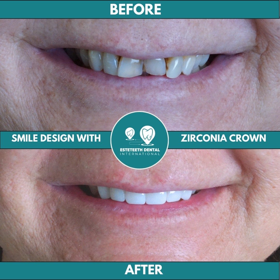 Before and after smile design with zirconia crown